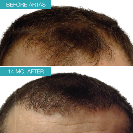 Real patient #3 before and after photo hair restoration