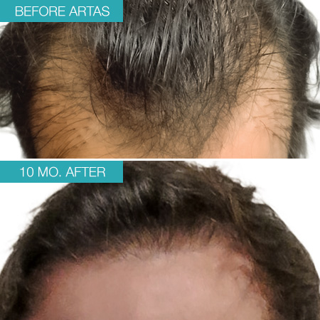Real patient #2 before and after photo hair restoration