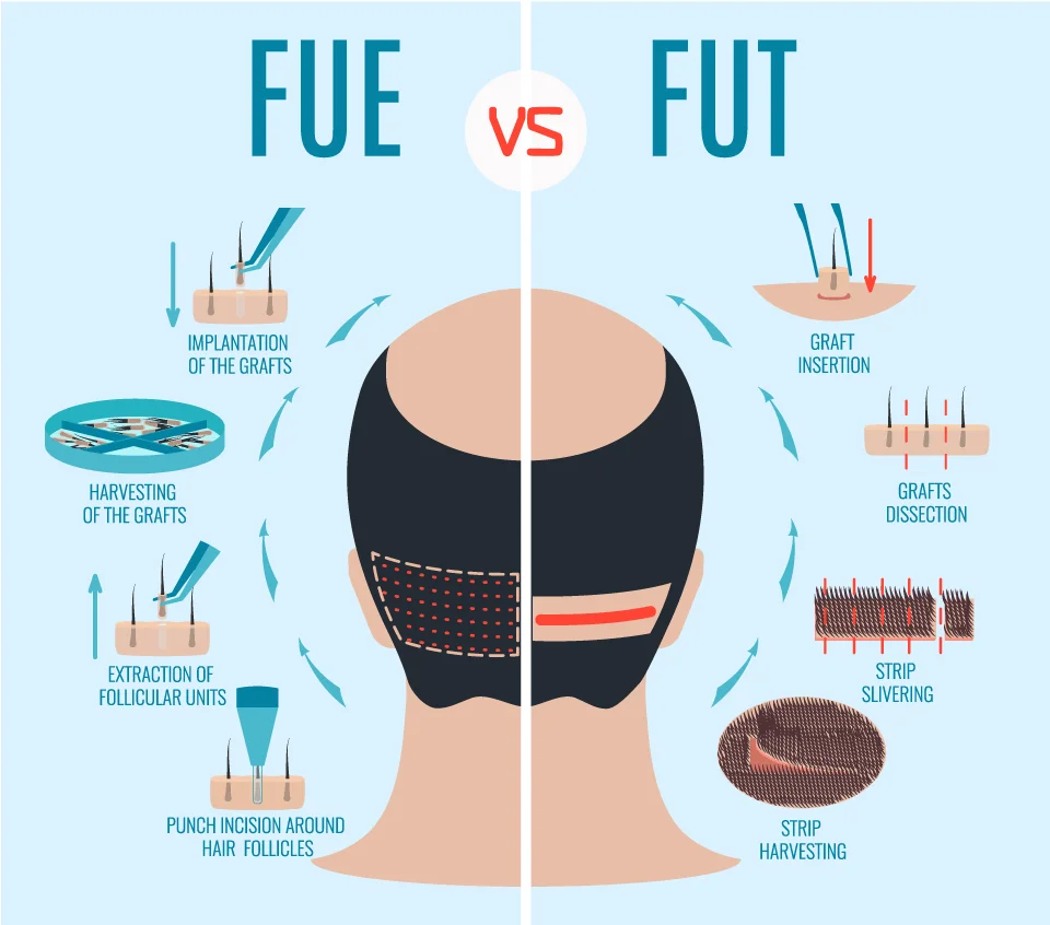 Illustration showing the comparison between FUE and FUT hair restoration