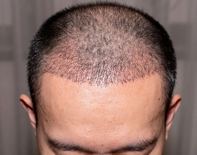 Real patient Hair Transplant after photo