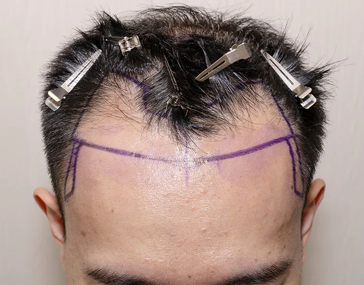 Real patient Hair Transplant before photo