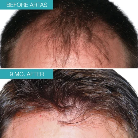 Real patient #1 before and after photo hair restoration